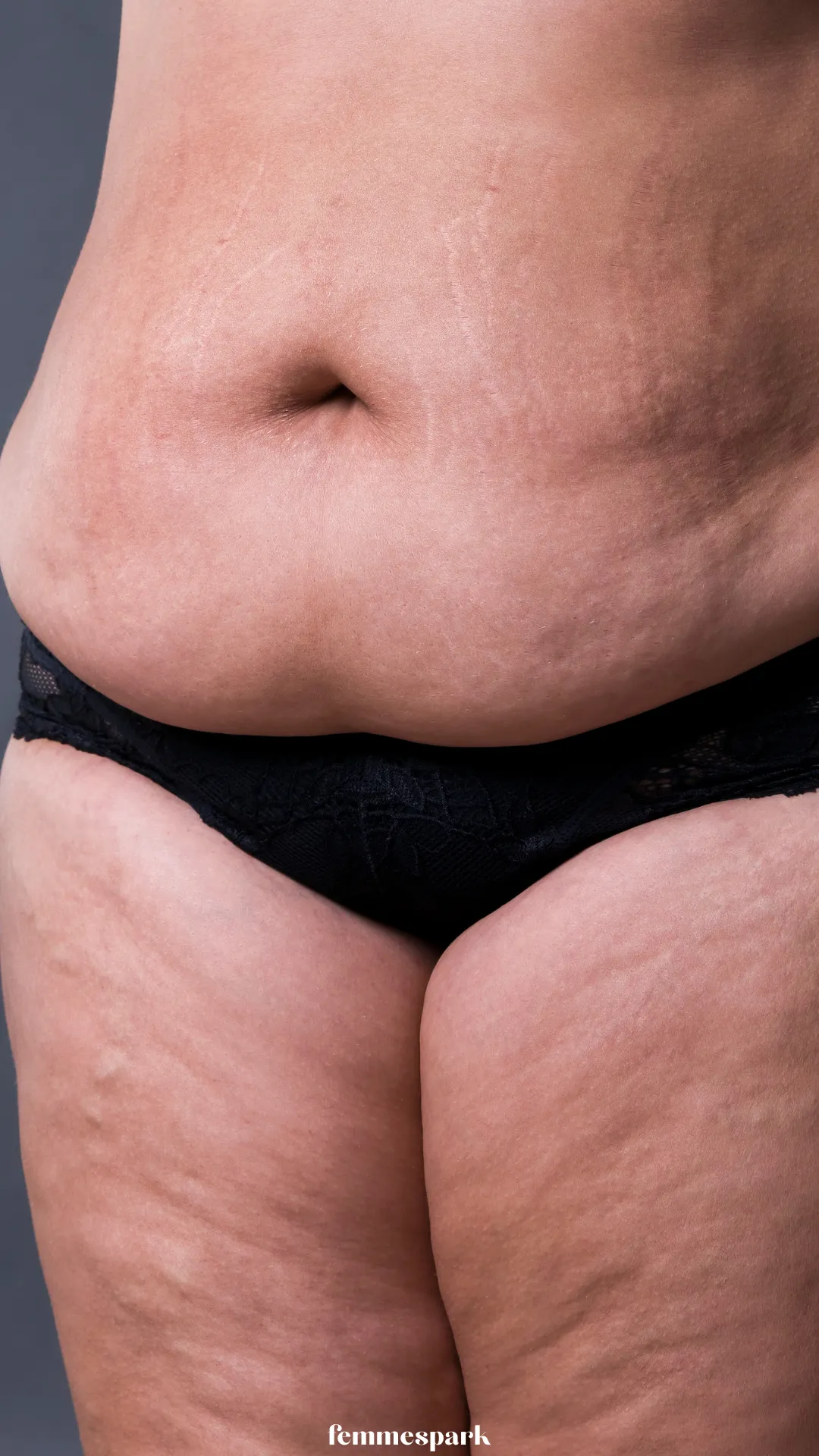 A close-up of a postpartum belly pooch with stretch marks, normalizing abdominal changes and stretched skin after pregnancy.
